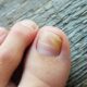 Toenail Fungus From Nail Polish A Comprehensive Guide