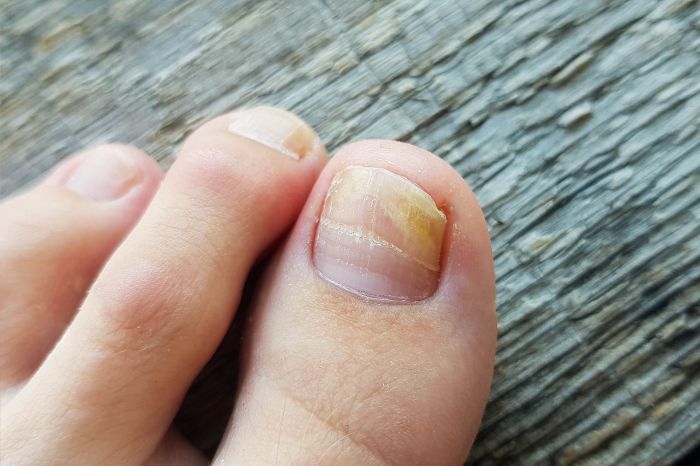 Toenail fungus from nail polish