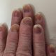 Nail discoloration from nail polish