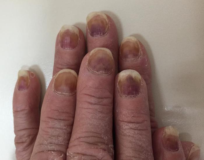 Nail discoloration from nail polish