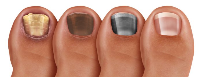 Discolored toenails do delray podiatry beach nails why have morguefile treatment via available